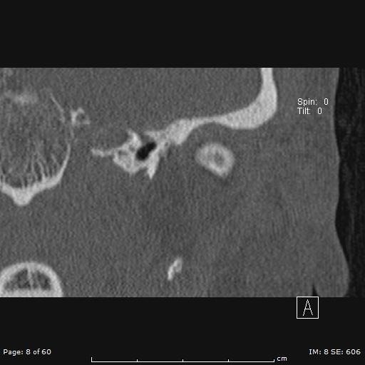 File:Cholesteatoma - external auditory canal (Radiopaedia 88452-105096 Coronal bone window 8).jpg