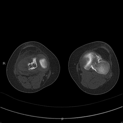 Chondroblastoma (Radiopaedia 62721-71030 Axial bone window 40).jpg