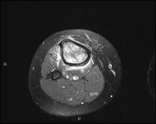 File:Chondroblastoma (Radiopaedia 62721-71031 Axial PD fat sat 30).jpg