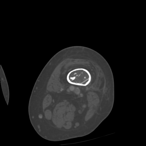 Chondrosarcoma - femur (Radiopaedia 64187-72954 Axial bone window 10).jpg