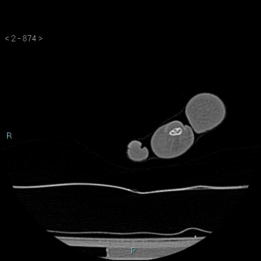 File:Chondrosarcoma - phalanx (Radiopaedia 69047-78812 Axial bone window 128).jpg