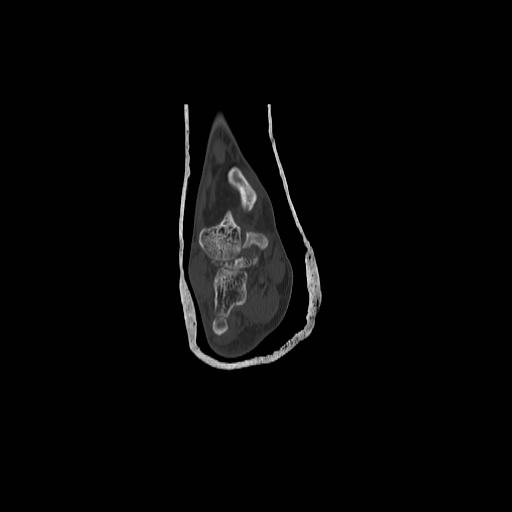 File:Chopart fracture (Radiopaedia 12386-12650 Coronal bone window 2).jpg