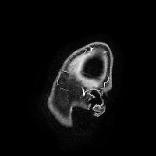 Chordoid glioma of third ventricle (Radiopaedia 91612-109340 F 17).jpg