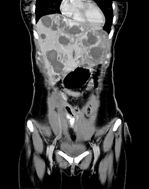 Choriocarcinoma liver metastases (Radiopaedia 74768-85766 B 31).jpg
