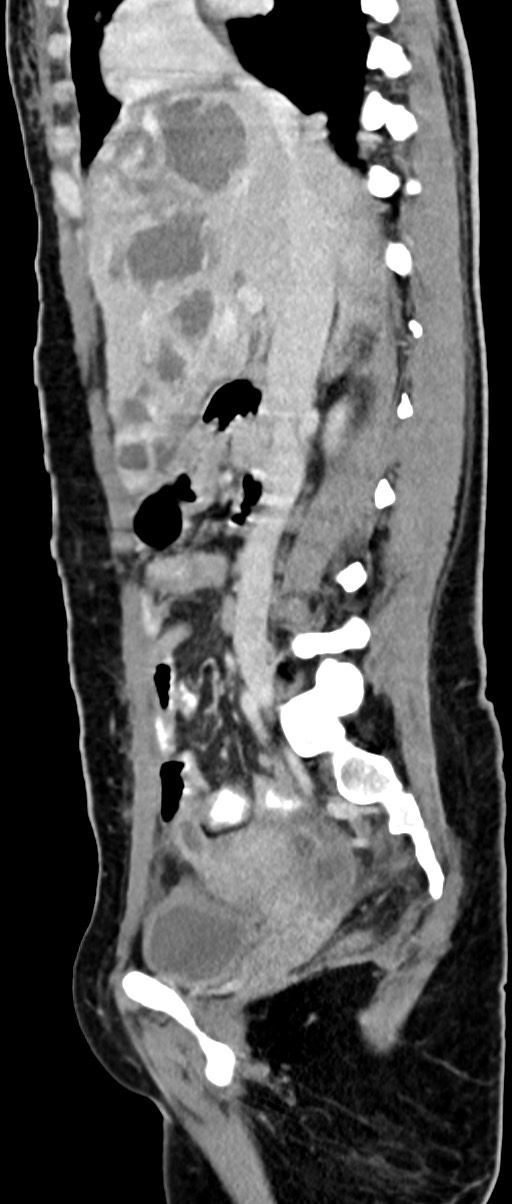 Choriocarcinoma liver metastases (Radiopaedia 74768-85766 C 110).jpg