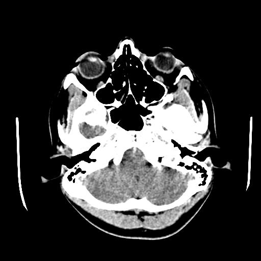 File:Choriocarcinoma of ovary with cerebral and pulmonary metastases (Radiopaedia 25983-26118 C+ arterial phase 18).jpg