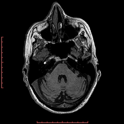 Choroid plexus xanthogranuloma (Radiopaedia 67843-77270 Axial T1 123).jpg
