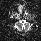 Choroid plexus xanthogranuloma - unilateral (Radiopaedia 85632-101393 Axial ADC 4).jpg
