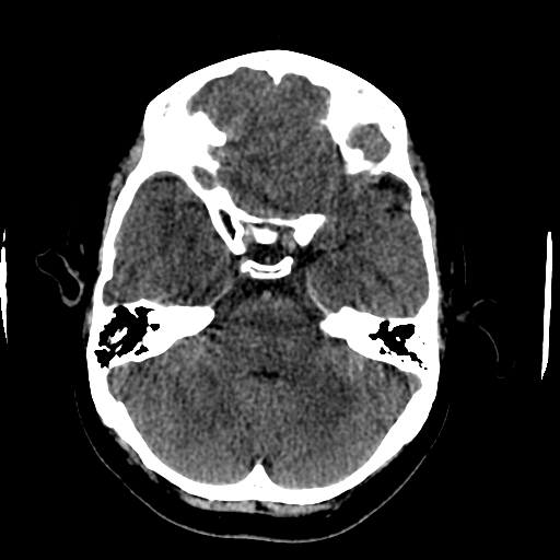 File:Choroid plexus xanthogranulomas (Radiopaedia 51621-57408 Axial non-contrast 27).jpg