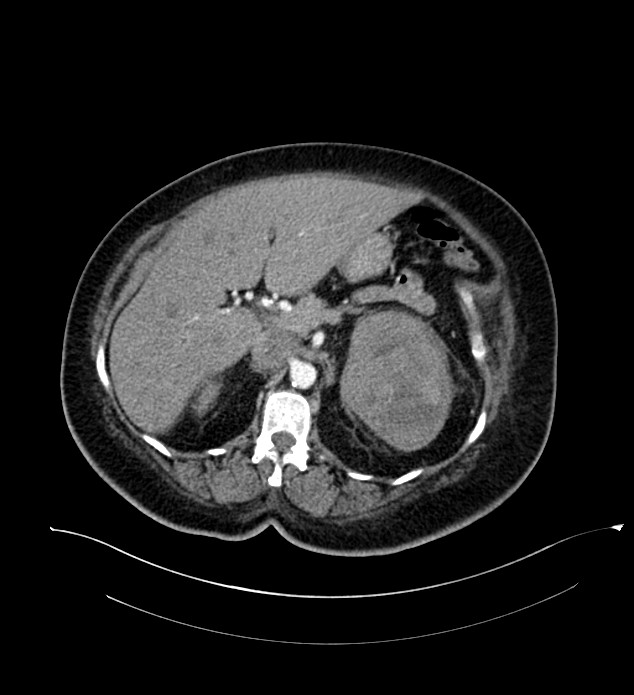 Chromophobe renal cell carcinoma (Radiopaedia 84239-99519 B 37).jpg