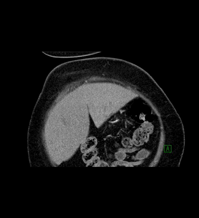 Chromophobe renal cell carcinoma (Radiopaedia 84239-99519 C 14).jpg