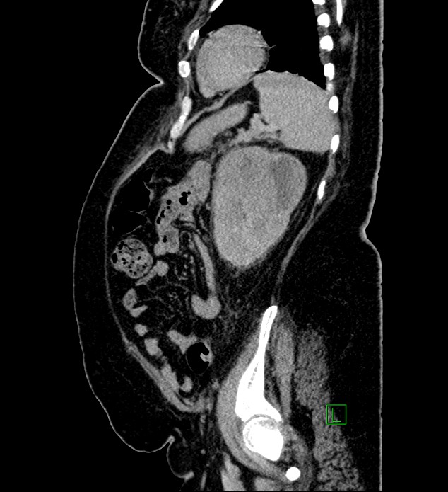 Chromophobe renal cell carcinoma (Radiopaedia 84239-99519 G 31).jpg