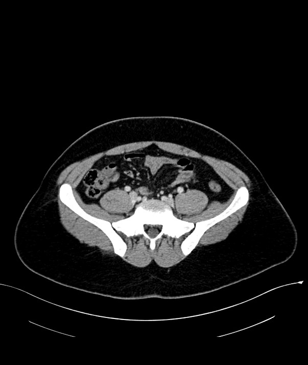 Chromophobe renal cell carcinoma (Radiopaedia 84255-99542 F 60).jpg
