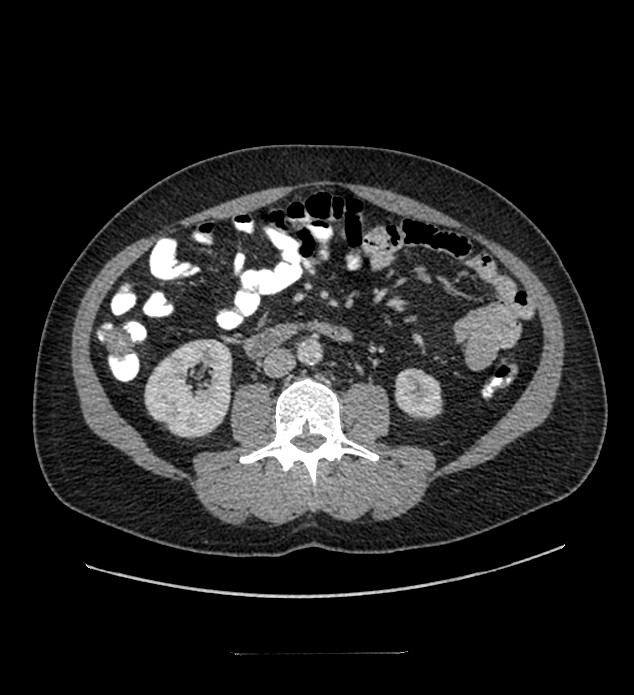 Chromophobe renal cell carcinoma (Radiopaedia 84337-99644 C 67).jpg