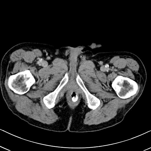 Chronic appendicitis complicated by appendicular abscess, pylephlebitis and liver abscess (Radiopaedia 54483-60700 B 155).jpg