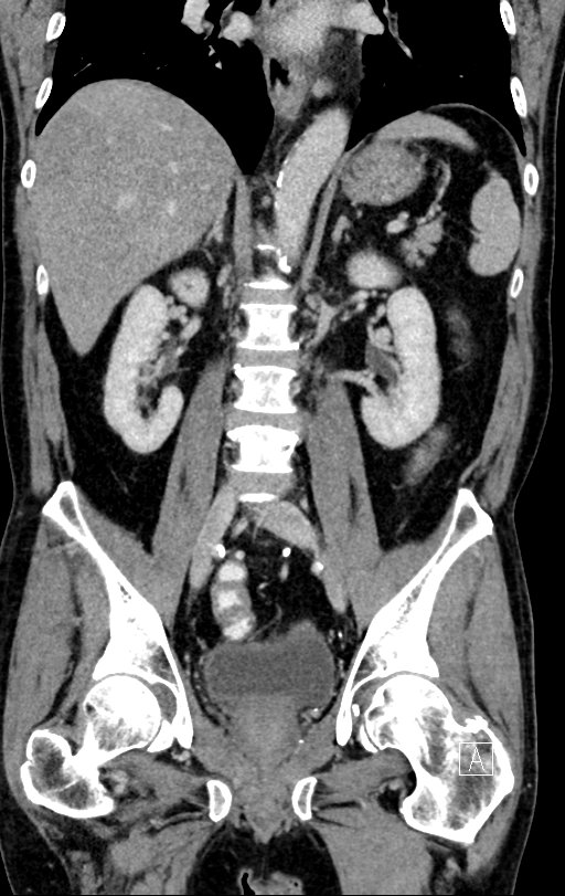 Chronic appendicitis complicated by appendicular abscess, pylephlebitis and liver abscess (Radiopaedia 54483-60700 C 49).jpg