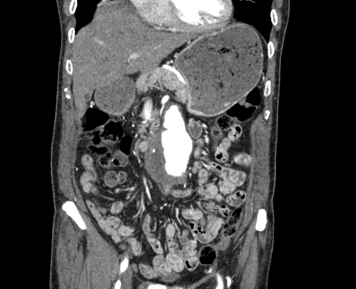 File:Chronic contained rupture of abdominal aortic aneurysm with extensive erosion of the vertebral bodies (Radiopaedia 55450-61901 D 17).jpg