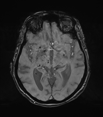 Chronic hypertensive encephalopathy (Radiopaedia 72844-83495 Axial SWI magnitude 38).png