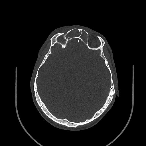 Chronic invasive fungal sinusitis (Radiopaedia 50342-55710 Axial bone window 107).jpg
