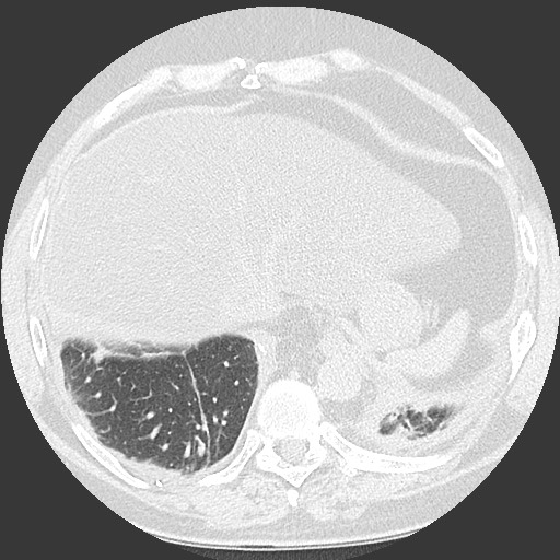 Chronic lung allograft dysfunction - restrictive form (Radiopaedia 60595-68316 Axial lung window 59).jpg
