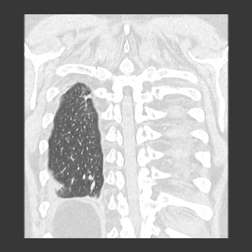 Chronic lung allograft dysfunction - restrictive form (Radiopaedia 60595-68316 Coronal lung window 81).jpg