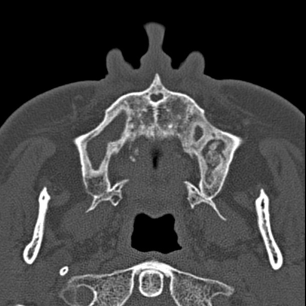 Chronic maxillary sinusitis (Radiopaedia 27879-28116 Axial bone window 6).jpg