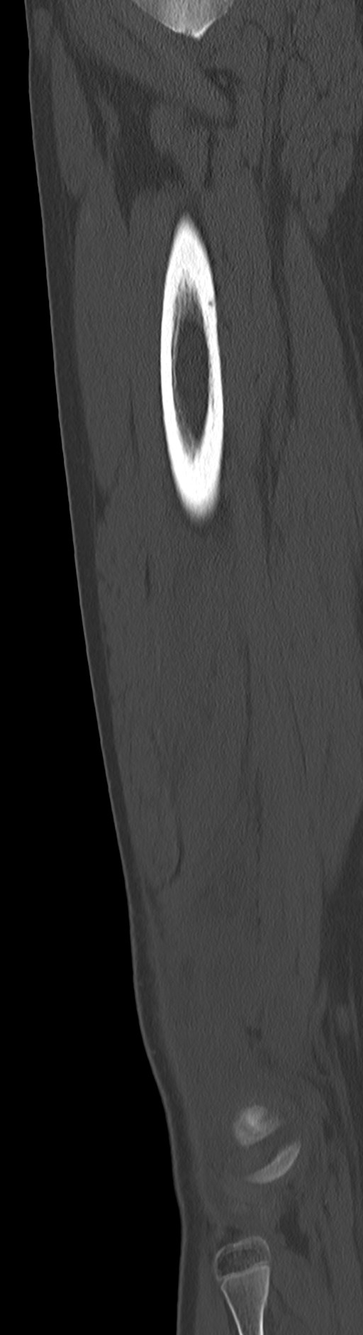 Chronic ostemyelitis of the femur with long sinus tract (Radiopaedia 74947-85982 Sagittal bone window 37).jpg