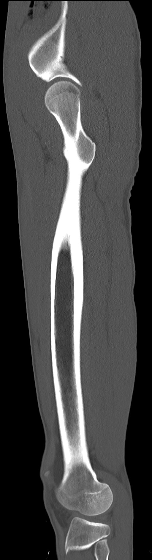 Chronic osteomyelitis (with sequestrum) (Radiopaedia 74813-85822 C 26).jpg