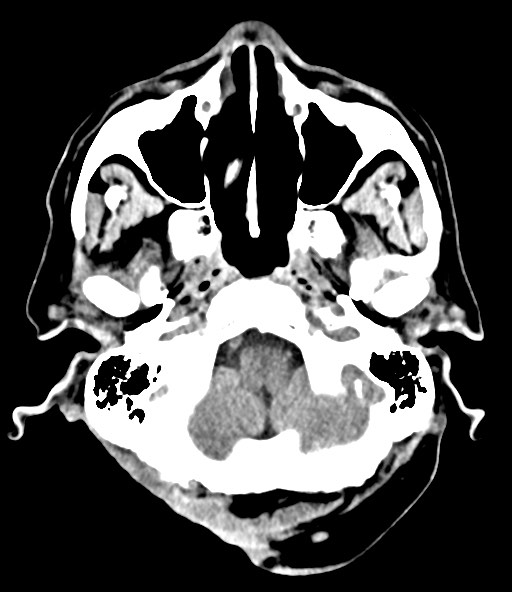 File:Chronic osteomyelitis - calvarial (severe) (Radiopaedia 69668-79616 Axial non-contrast 28).jpg