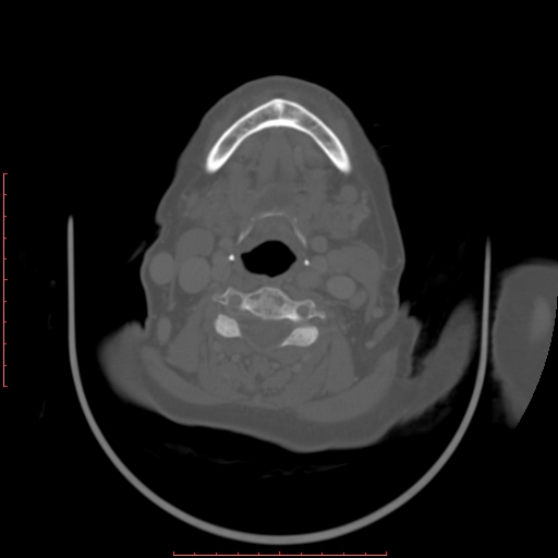 Chronic osteomyelitis - maxilla (Radiopaedia 23783-23927 Axial bone window 14).jpg