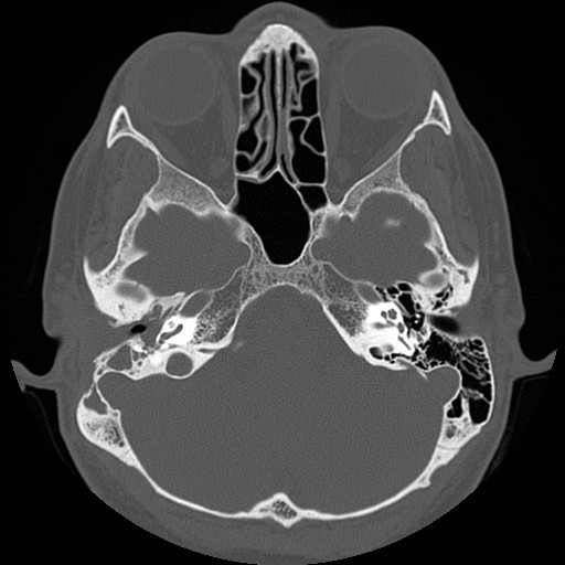 File:Chronic otomastoiditis (Radiopaedia 27138-27309 Axial bone window 30).jpg