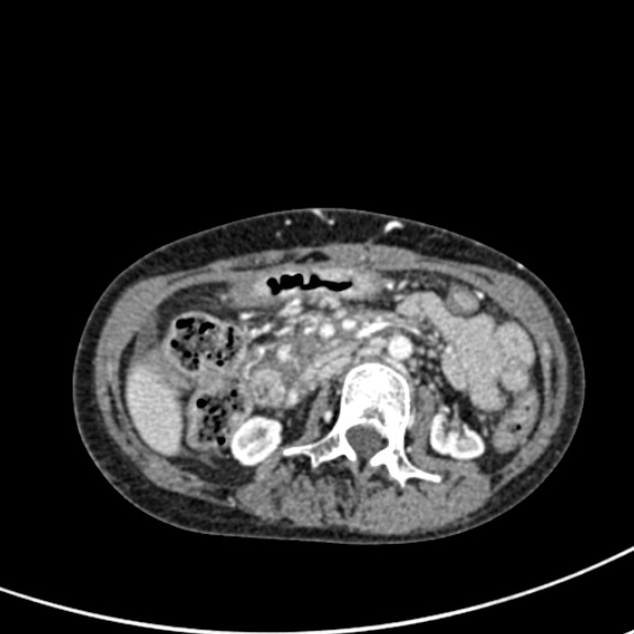 File:Chronic pancreatitis (Radiopaedia 55405-61846 A 46).jpg
