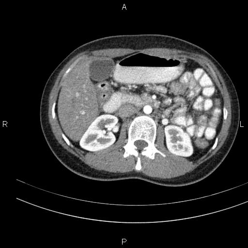 Chronic pancreatitis (Radiopaedia 64576-73450 B 64).jpg
