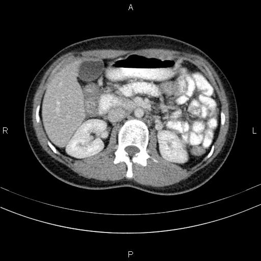Chronic pancreatitis (Radiopaedia 64576-73450 C 65).jpg