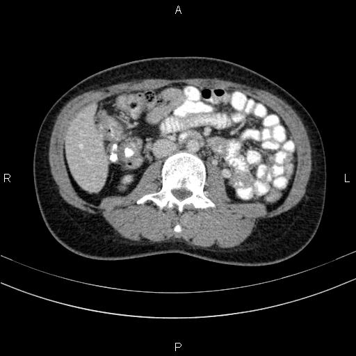 Chronic pancreatitis (Radiopaedia 64576-73450 C 84).jpg