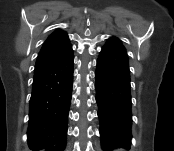 Chronic pulmonary embolus (Radiopaedia 39129-41341 Coronal C+ CTPA 69).png
