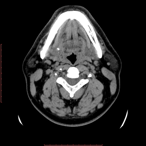 Chronic submandibular sialolithiasis (Radiopaedia 69817-79814 Axial non-contrast 107).jpg