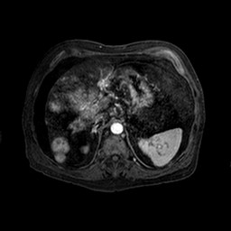 Cirrhosis and hepatocellular carcinoma in the setting of hemochromatosis (Radiopaedia 75394-86594 Axial T1 C+ fat sat 134).jpg
