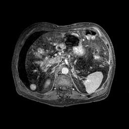 File:Cirrhosis and hepatocellular carcinoma in the setting of hemochromatosis (Radiopaedia 75394-86594 Axial T1 C+ fat sat 303).jpg