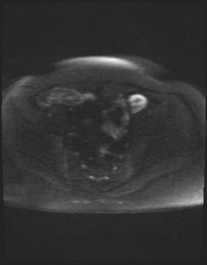 Class II Mullerian duct anomaly- unicornuate uterus with rudimentary horn and non-communicating cavity (Radiopaedia 39441-41755 Axial DWI 41).jpg