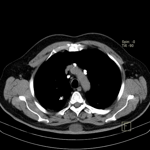 Classic complicated silicosis (Radiopaedia 49720-54961 Axial liver window 15).jpg