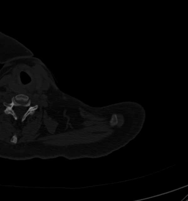 Clear cell chondrosarcoma - humerus (Radiopaedia 63104-71612 Axial bone window 4).jpg