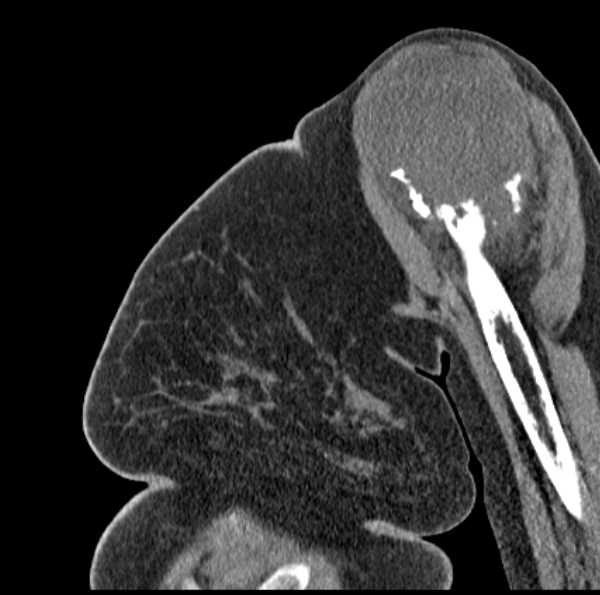 File:Clear cell chondrosarcoma - humerus (Radiopaedia 63104-71612 D 18).jpg