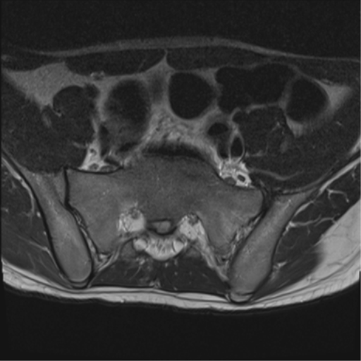 File:Clear cell meningoma - lumbar spine (Radiopaedia 60116-67690 Axial T2 2).png