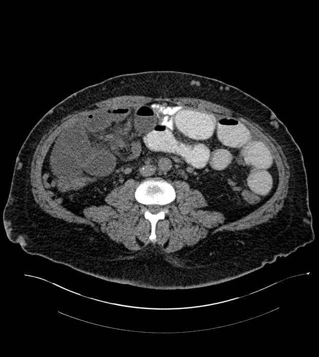 Closed-loop small bowel obstruction-internal hernia (Radiopaedia 78439-91096 Axial non-contrast 88).jpg
