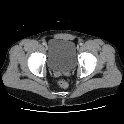 File:Closed-loop small bowel obstruction (Radiopaedia 73713-84509 A 157).jpg