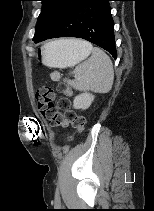 Closed loop obstruction - internal hernia into nephrectomy bed (Radiopaedia 59867-67320 C 10).jpg