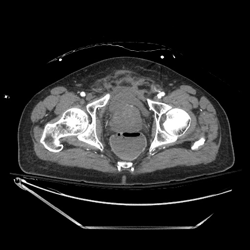 File:Closed loop obstruction due to adhesive band, resulting in small bowel ischemia and resection (Radiopaedia 83835-99023 B 147).jpg