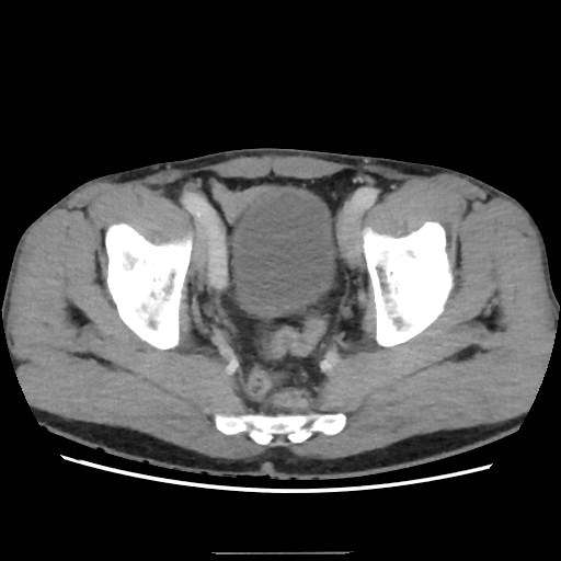 Closed loop small bowel obstruction (Radiopaedia 59227-66554 A 75).jpg