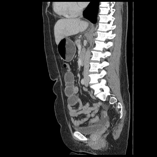 File:Closed loop small bowel obstruction (Radiopaedia 65403-74451 C 48).jpg